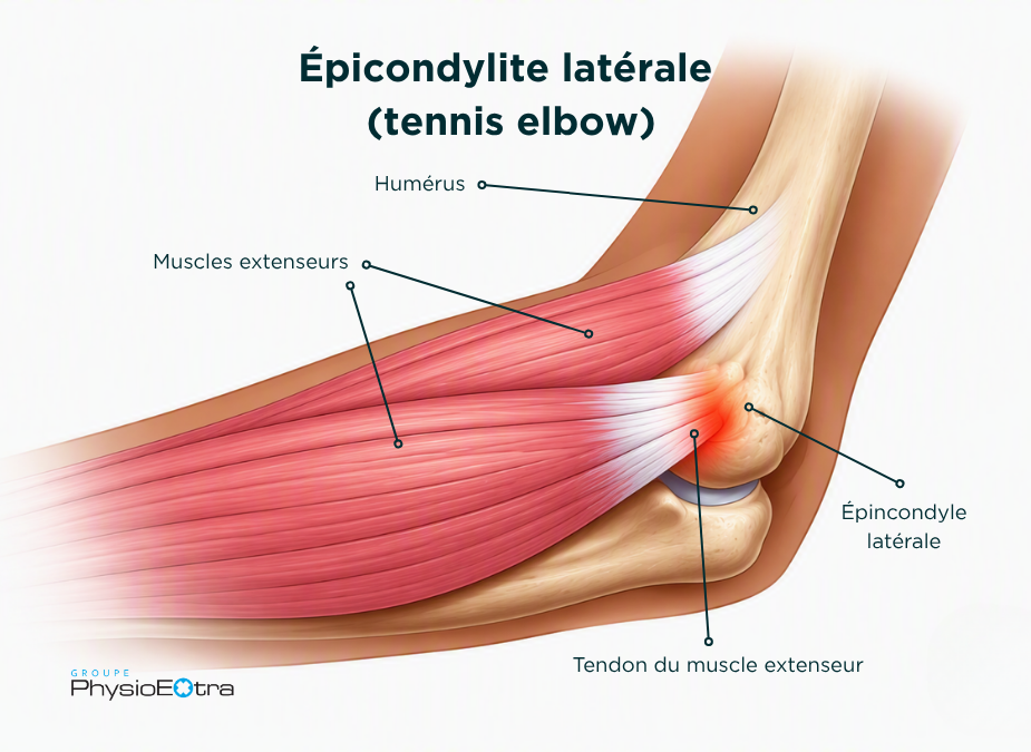 Illustration anatomique du coude montrant l’épicondylite latérale (tennis elbow). Les muscles extenseurs de l’avant-bras et leur tendon sont reliés à l’épicondyle latéral de l’humérus, avec une zone rouge indiquant l’inflammation ou la douleur au point d’insertion du tendon.