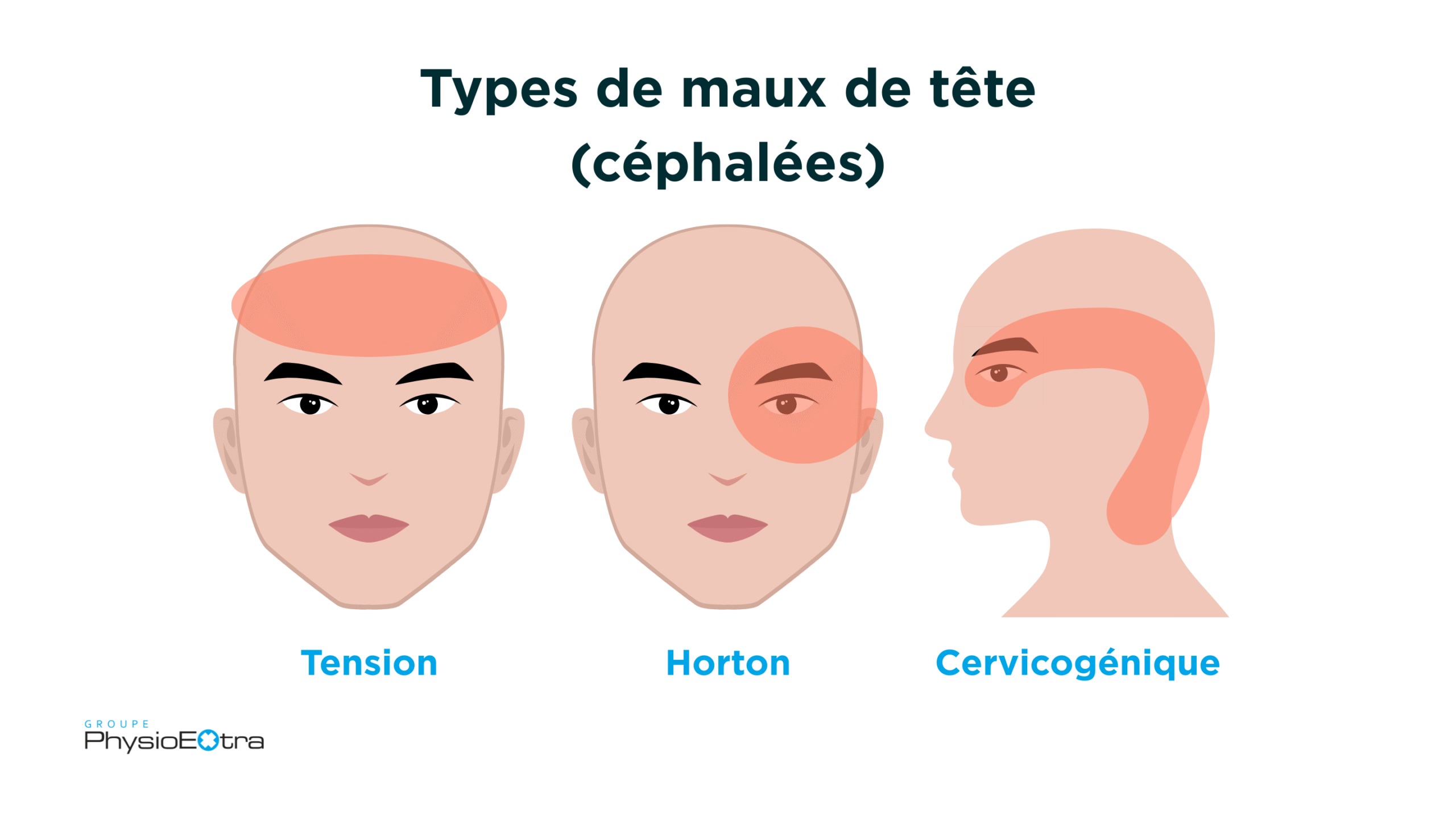 types de maux de tête (céphalées) - tension, horton et cervicogénique