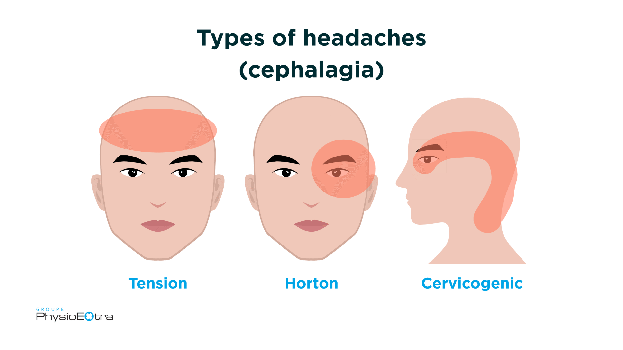 Types of headaches