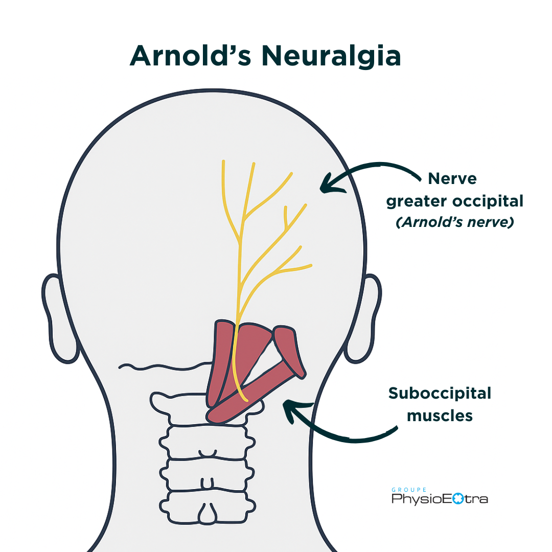 Medical illustration of Arnold's neuralgia showing the location of the greater occipital nerve (also called Arnold's nerve) and the suboccipital muscles at the back of the head and neck. The diagram highlights the nerve in yellow and the muscles in red, with explanatory arrows.