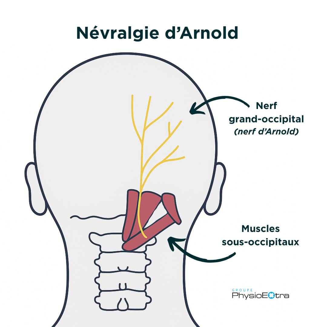 Illustration médicale de la névralgie d’Arnold montrant l’emplacement du nerf grand-occipital (aussi appelé nerf d’Arnold) et des muscles sous-occipitaux à l’arrière de la tête et du cou. Le schéma identifie le trajet du nerf en jaune et les muscles en rouge, avec des flèches explicatives.
