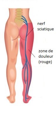nerf sciatique_PhysioExtra