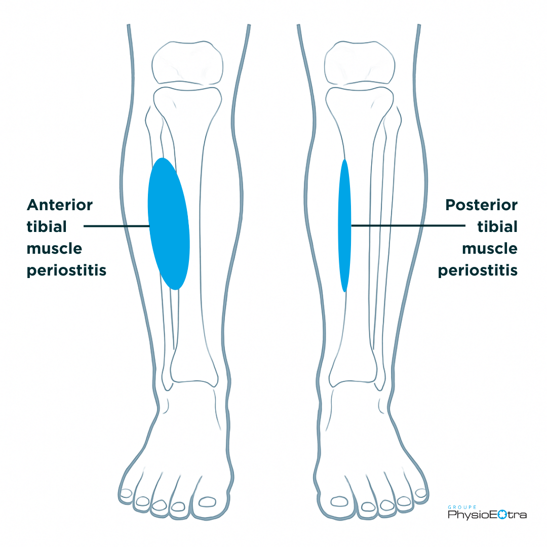 shin-splint-anterior-posterior-physioextra