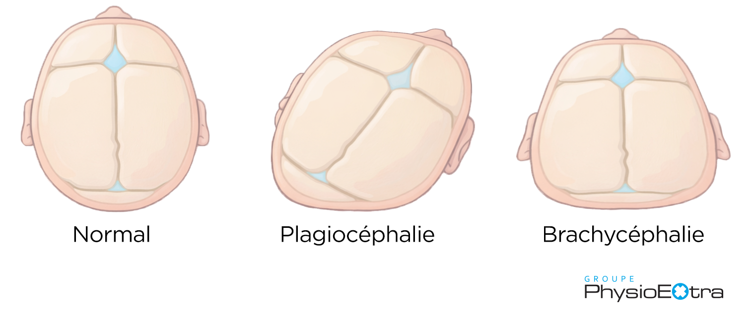 tête plate chez le bébé - normal, plagiocéphalie et brachycéphalie